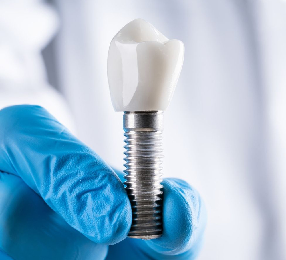 Dental implants dentist in Kingston bone health assessment at Greenwood Park Dentistry
