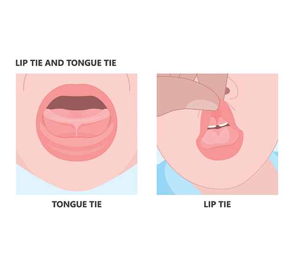 lip-tie-tongue-tie