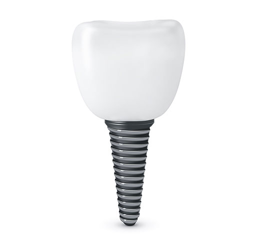 dental-implant